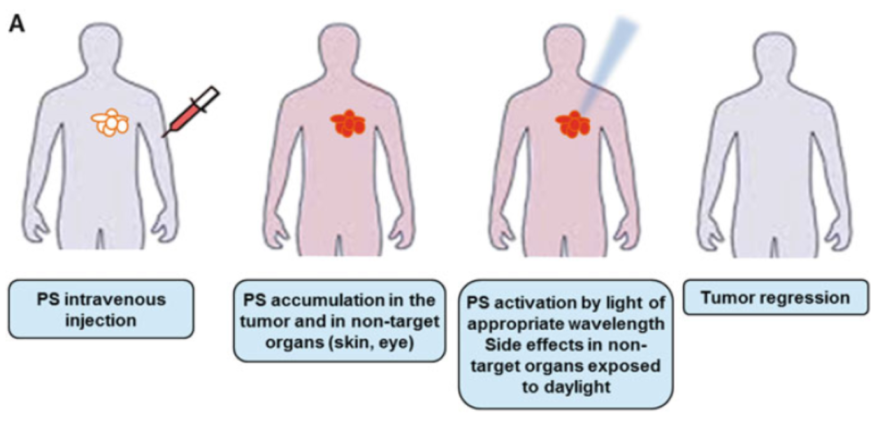 「肿瘤光动力治疗（PDT）」介绍及纳米材料的潜在应用